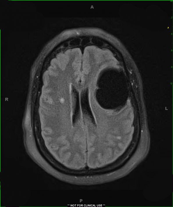 3A Cyst, arachnoid (Case 3) FLAIR 9