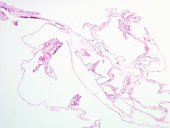 3B1 Cyst, arachnoid (Case 3) H&E 1