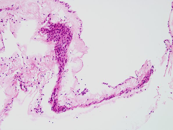 3B2 Cyst, arachnoid (Case 3) H&E 3