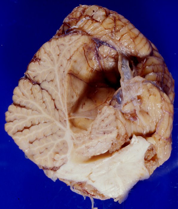 4A1 Cyst, Arachnoid (Case 4)