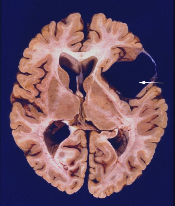 4A2 Cyst, Arachnoid (Case 4) 2