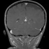 5A1 Cyst, Arachnoid (Case 5) T1W 2