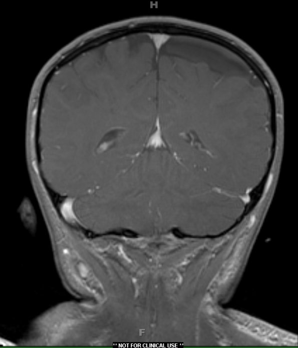 5A1 Cyst, Arachnoid (Case 5) T1W 2