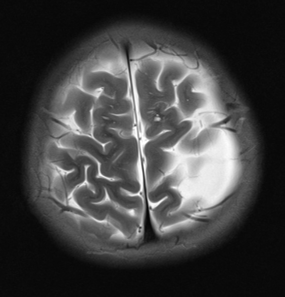 5A3 Cyst, Arachnoid (Case 5) T2W 1