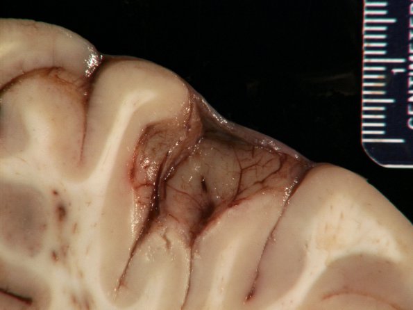 5B Cyst, arachnoid (Case 5) 1