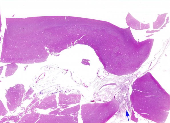 5C1 Arachnoid cyst (Case 5) N16 H&E whole mount