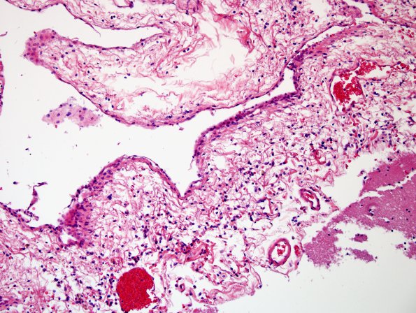 5C3 Arachnoid cyst (Case 5) N16 H&E 20X