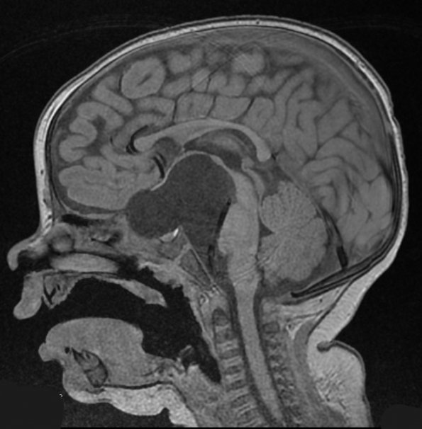 6A1 Cyst, arachnoid (Case 6) T1 