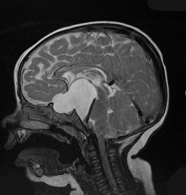 6A2 Cyst, arachnoid (Case 6) T2 2