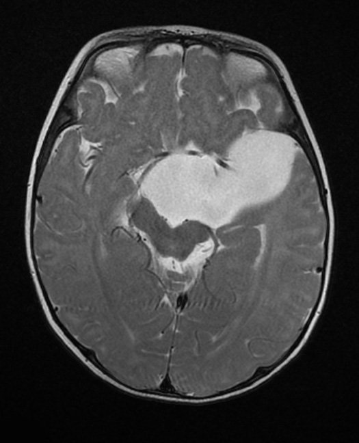 6A3 Cyst, arachnoid (Case 6) T2 3