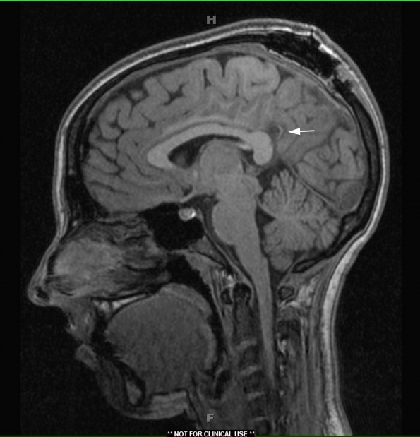 7A1 Arachnoid Cyst (Case 7) T1