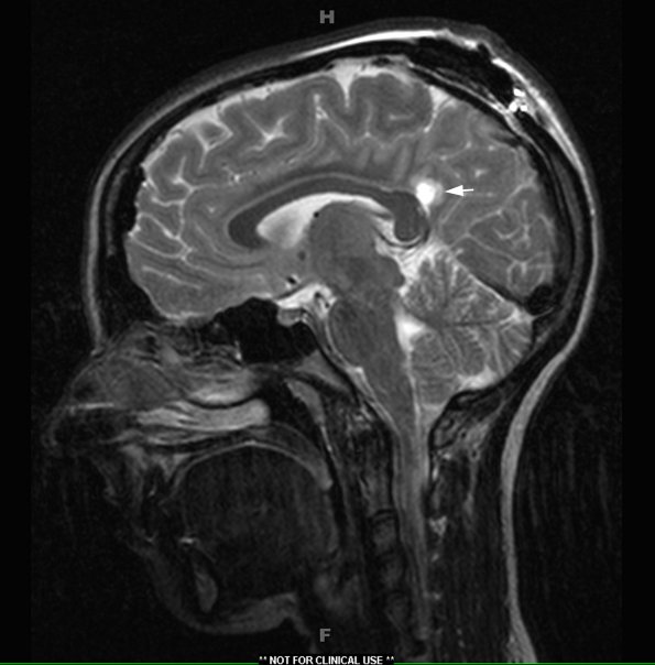 7A2 Arachnoid Cyst (Case 7) T2