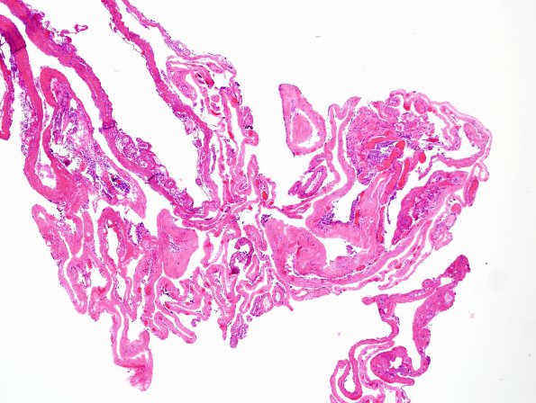 7B1 Cyst, arachnoid, intraparenchymal (Case 7) H&E 2