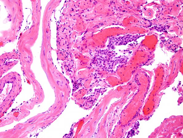 7B2 Cyst, arachnoid intraparenchymal (Case 7) H&E 1