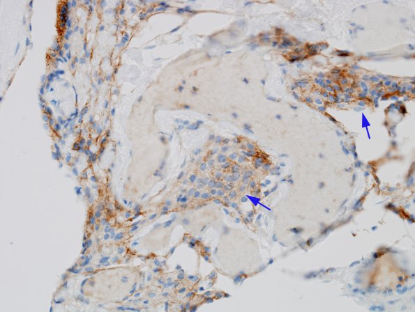 7C Cyst, arachnoid, intraparenchymal (Case 7) EMA