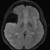 8A1 Cyst, arachnoid (Case 8) FLAIR