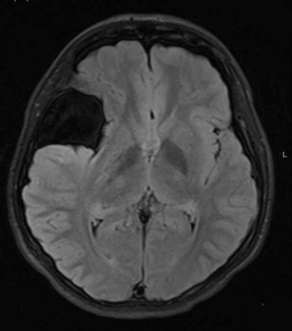 8A1 Cyst, arachnoid (Case 8) FLAIR