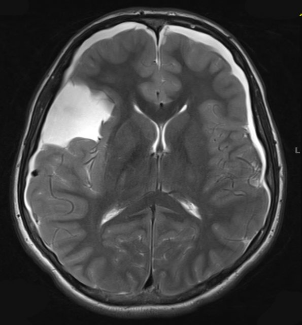 8A2 Cyst, arachnoid (Case 8) T2