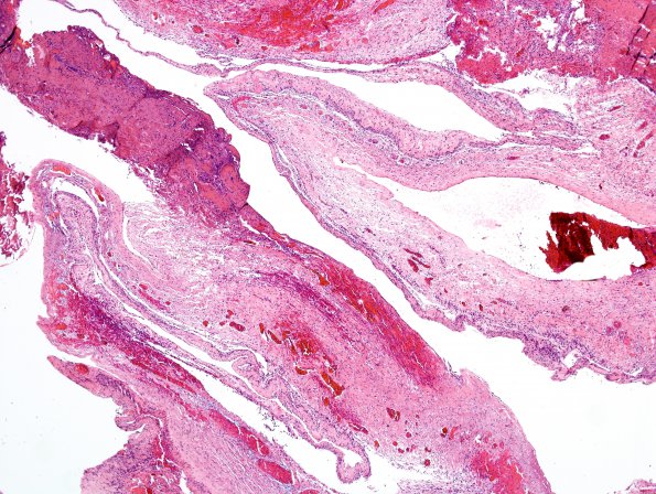 8B1 Cyst, arachnoid (Case 8) H&E 1