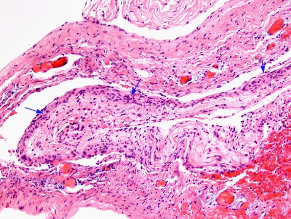 8B2 Cyst, arachnoid (Case 8) H&E 2