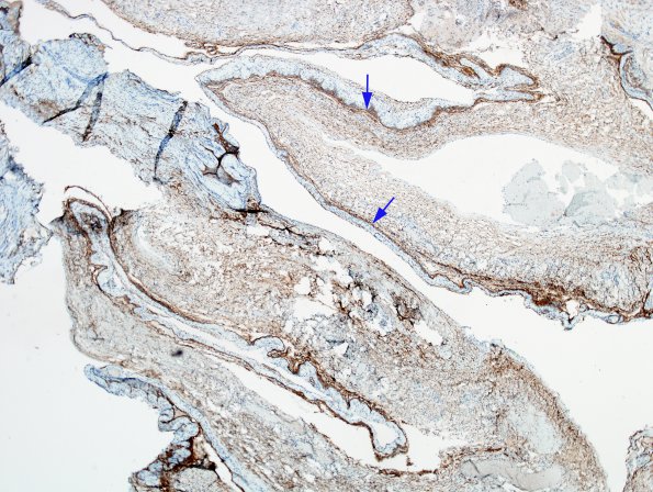 8C1 Cyst, arachnoid (Case 8) EMA 2