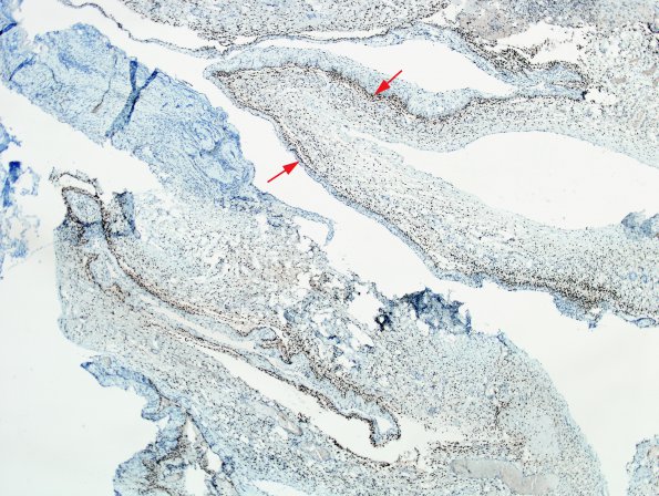 8C2 Cyst, arachnoid (Case 8) PR 1