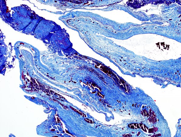 8D Cyst, arachnoid (Case 8) Trichrome 2