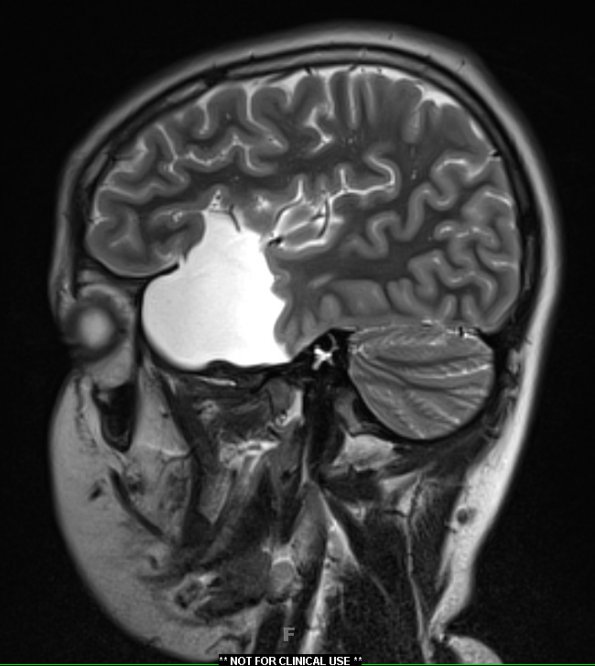 9A Arachnoid Cyst (Case 9) T2 W2