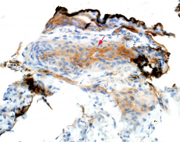 9C1 Cyst, arachnoid (Case 9) EMA 2