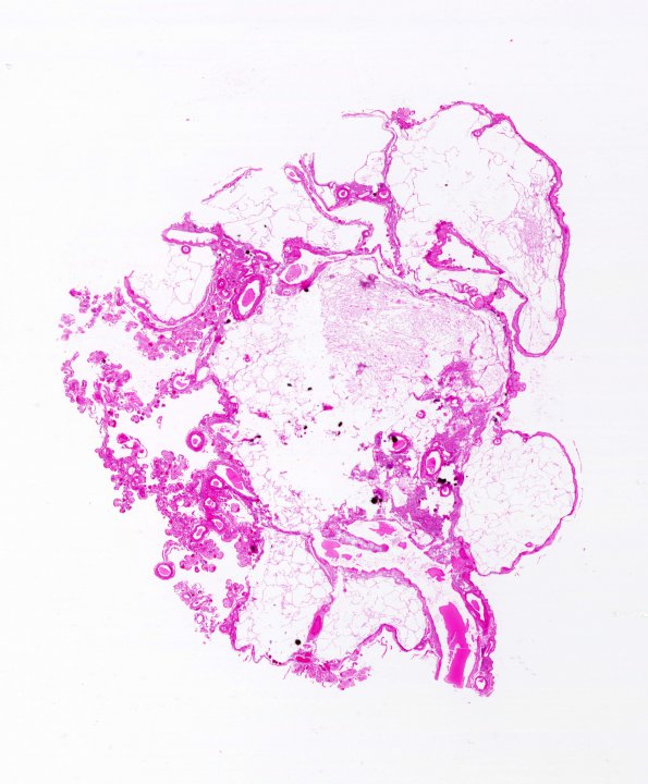 2A1 Cyst, choroid plexus (Case 2) H&E whole mount