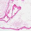 2A2 Cyst, choroid plexus (Case 2) H&E 1