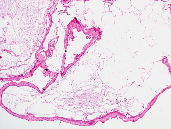 2A2 Cyst, choroid plexus (Case 2) H&E 1