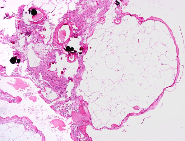 2A3 Cyst, choroid plexus (Case 2) H&E 2