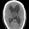 10A Cyst, colloid (Case 10) CT 1