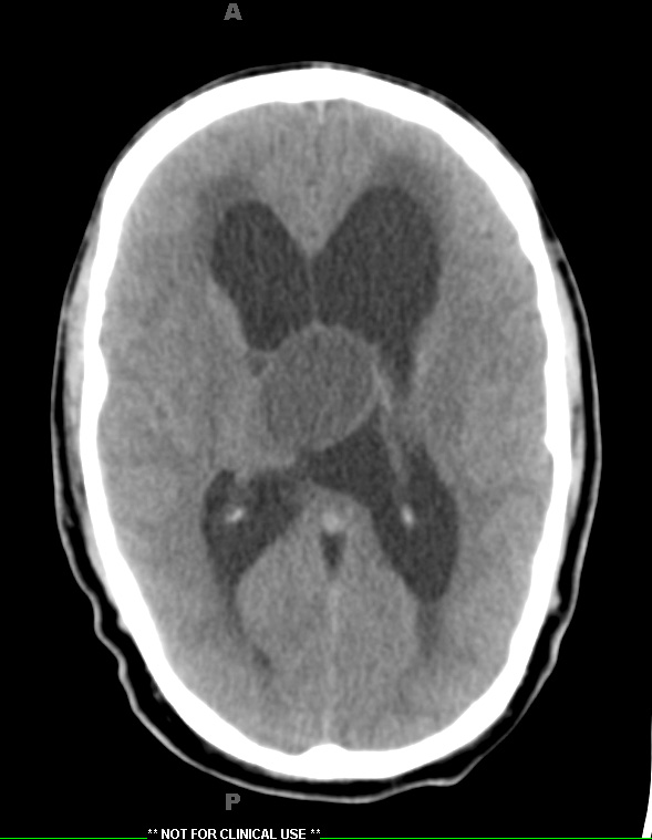 10A Cyst, colloid (Case 10) CT 1