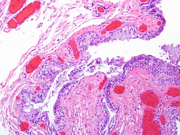 10B1 Cyst, colloid (Case 10) H&E 2