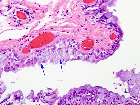 10B2 Cyst, colloid (Case 10) H&E 1