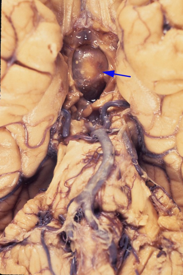 11A1 Cyst, colloid (Case 11) 1