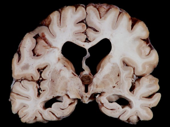 12A1 Cyst, colloid (Case 12) gross_1