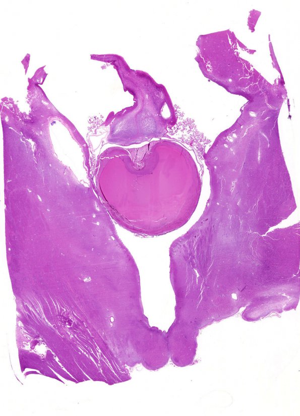 12B1 Cyst, colloid (Case 12) H&E whole mount