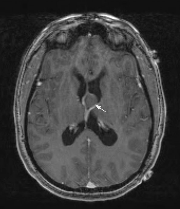 13A1 Cyst, colloid (Case 13) T1 3D