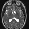 13A2 Cyst, colloid (Case 13) T2