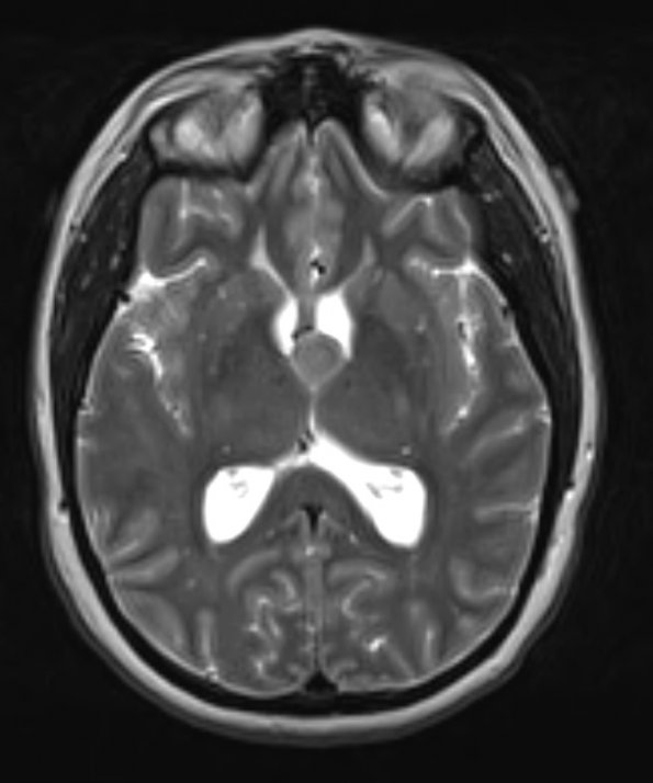 13A2 Cyst, colloid (Case 13) T2