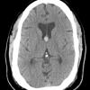 14A Cyst, Colloid (Case 14) CT 1