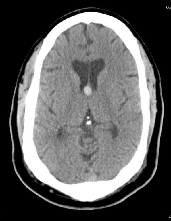 14A Cyst, Colloid (Case 14) CT 1