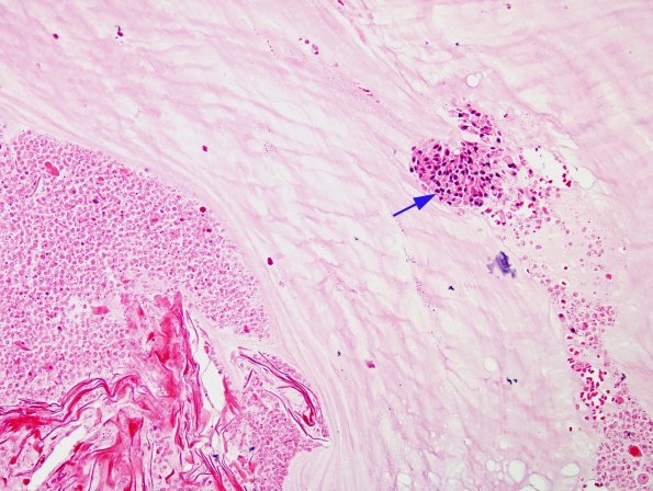 14B Cyst, Colloid (Case 14) H&E 1