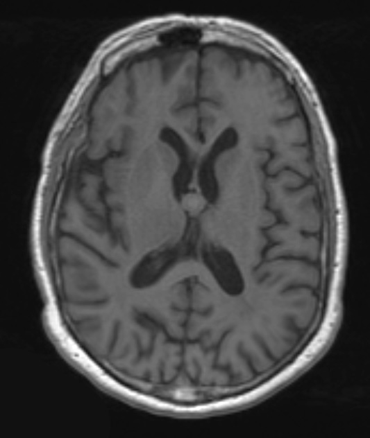 15A Colloid Cyst (Case 15) FRA 3D T1 GRE & C