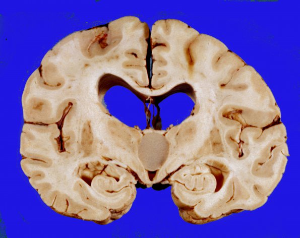 16 Cyst, colloid (Case 16) 1