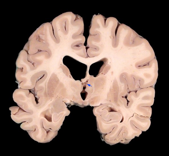 18A1 Cyst, colloid (Case 18)_1