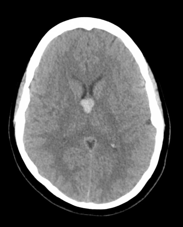 1A1 Cyst, colloid (Case 1) CT